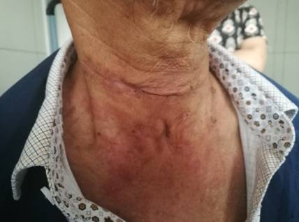  黄蜂三球接受左腕手术根治  